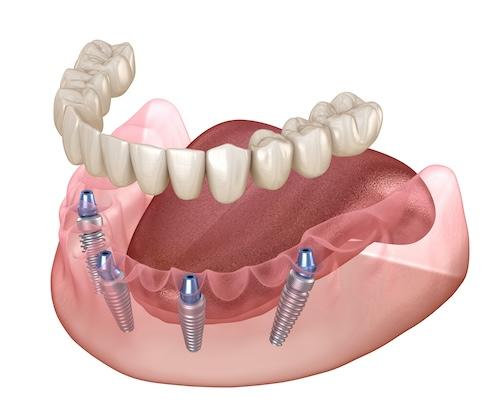 Graphic illustration of All-on-X dental implants procedure for new permanent teeth