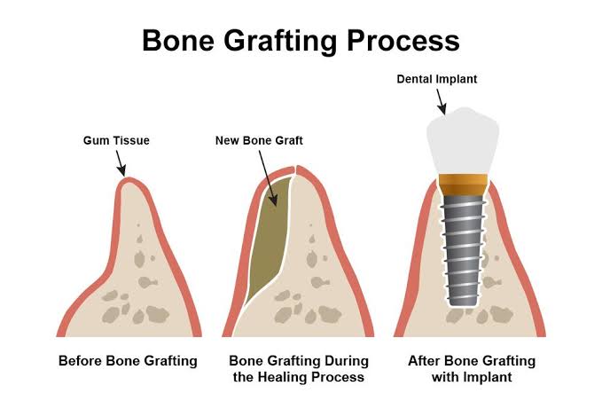 bone grafting process illustration | bone grafting riverside ca