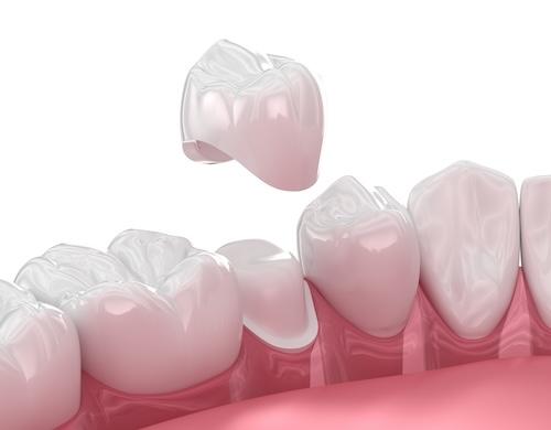 dental crown illustration