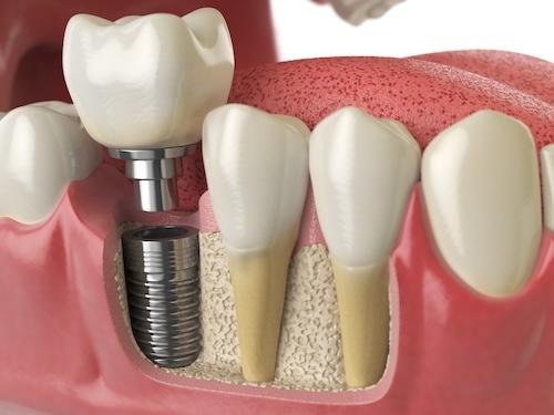 dental implant with screw illustration