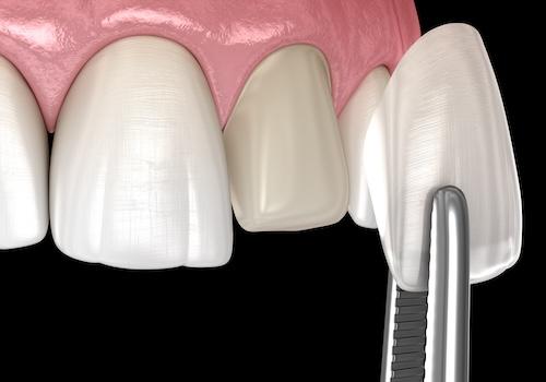 dental veneers side by side with a tooth